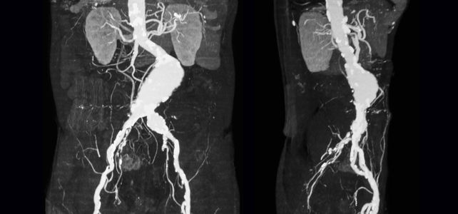 Screening Der Bauchschlagader Risikopatienten Sollten Jetzt Einen
